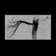 Stenosis of renal artery, stent: AG - Angiography